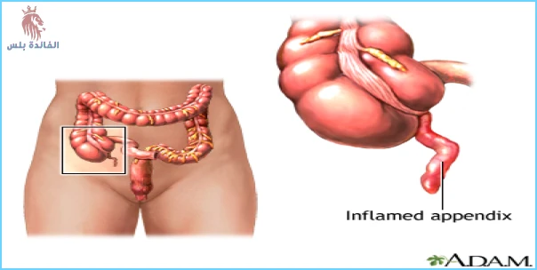 أعراض التهاب الأمعاء والقولون